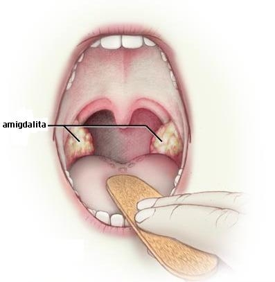 imagini angina streptococica